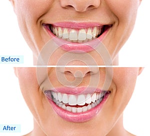 Whitening - bleaching treatment ,woman teeth and smile, before a