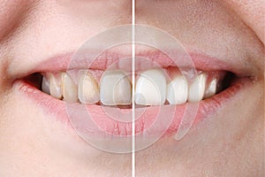 Whitening or bleaching treatment ,before and after ,woman teeth and smile, close up,  on white photo