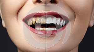 Before and after whitening treatment or dental veneers on teeth. Health Care collage of human mouth. Caries therapy