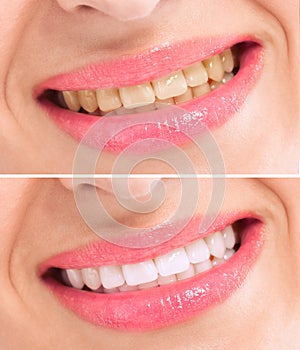 Before and after whitening treatment teeth