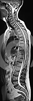 WHOLE SPINE MRI