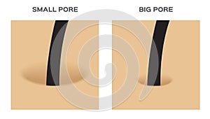 Wide and small hair follicle , pore . skin photo