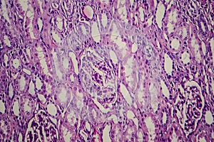 Wilms tumor, light micrograph