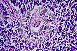 Wilms tumor, light micrograph