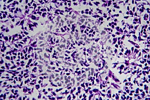 Wilms tumor, light micrograph