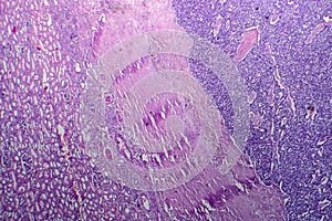 Wilms tumor, light micrograph