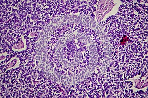 Wilms tumor, light micrograph