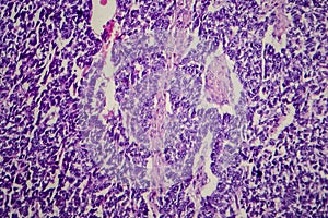 Wilms tumor, light micrograph