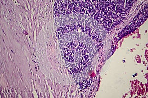 Wilms tumor, light micrograph