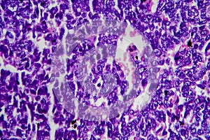 Wilms tumor, light micrograph