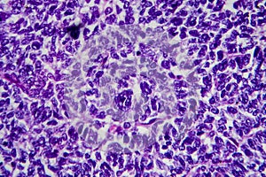 Wilms tumor, light micrograph