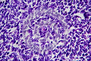 Wilms tumor, light micrograph