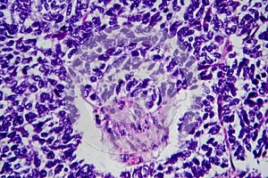 Wilms tumor, light micrograph