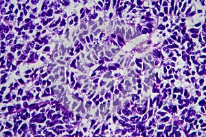 Wilms tumor, light micrograph