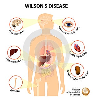 Wilson's disease