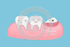 Wisdom teeth illustration.