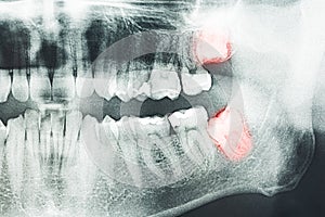 Wisdom Teeth Pain