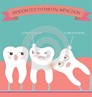 Wisdom Teeth Partial Eruption Impaction