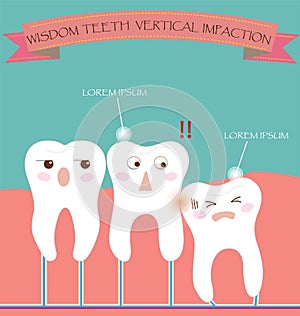 Wisdom Teeth Vertical Impaction