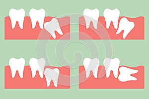 Wisdom tooth