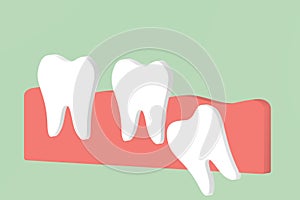 Wisdom tooth angular or mesial impaction affect to other teeth photo