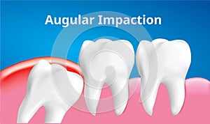 Wisdom tooth Angular or mesial impaction with inflammation affect , Dental concept, Realistic Vector photo