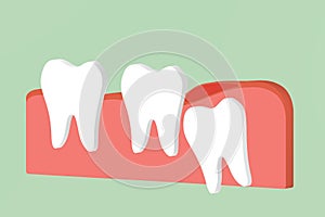 Wisdom tooth angular or mesial impaction with inflammation affect to other teeth photo