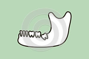 Wisdom tooth angular or mesial impaction in mandible or lower jaw photo