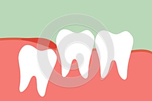 Wisdom tooth