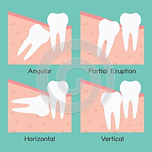 Wisdom Tooth