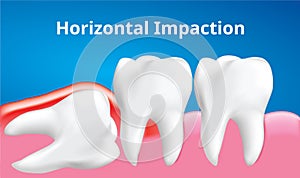 Wisdom tooth Horizontal impaction with inflammation affect , Dental care concept, Realistic Vector