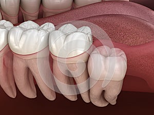 Wisdom tooth with impaction at molar tooth. Medically accurate tooth illustration photo