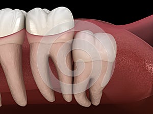 Wisdom tooth with impaction at molar tooth. Medically accurate tooth 3D illustration