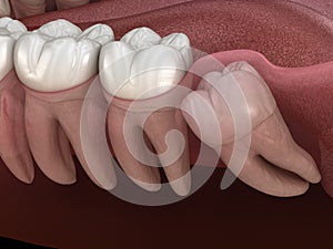 Wisdom tooth with impaction at molar tooth. Medically accurate tooth illustration