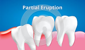 Wisdom tooth Partital Eruption with inflammation affect , Dental care concept, Realistic Vector