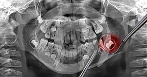 Wisdom tooth, x-ray dental scan