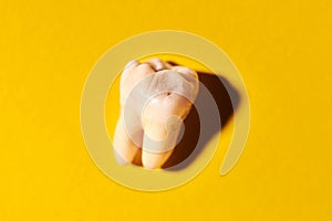Wisdom tooth with tooth decay, yellow background
