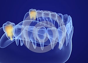 Wisdom tooth xray view. Medically accurate tooth illustration