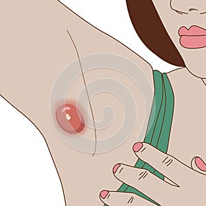 A woman with a abscess on her armpit. Illustration on white background