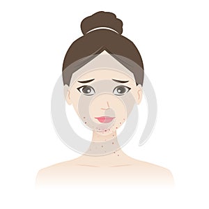 The woman with acne on jawline and neck vector illustration isolated on white background.