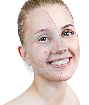 Woman with acne before and after treatment and make-up.