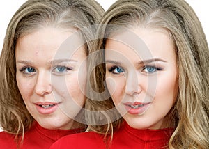 Woman with acne before and after treatment and makeup.