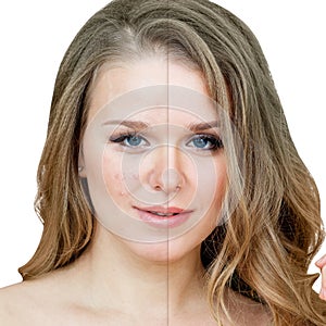 Woman with acne before and after treatment and makeup.