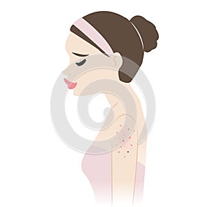 The woman with acne on upper arms vector illustration isolated on white background.