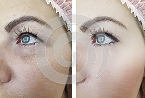 Woman adult  beauty wrinkles removal difference treatment antiaging cosmetology before and after correction procedures