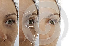 Woman adult face wrinkles effect aging difference after result procedure lifting regeneration orrection treatment