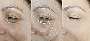 Woman adult face wrinkles effect aging after result procedure lifting regeneration orrection treatment