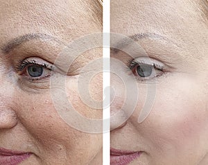 Woman adult wrinkles before after effect cosmetology correction contrast results