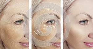 Woman adult wrinkles removal lifting before after collage cosmetology regeneration treatments