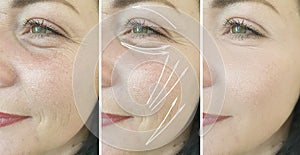 Woman adult wrinkles skin after therapy plastic result collagen effect lifting procedure treatment, thread lifting